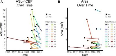 Arterial spin labeled perfusion MRI for the assessment of radiation-treated meningiomas